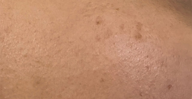 How are freckles different from melasma?