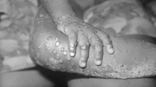 How dangerous is monkeypox?