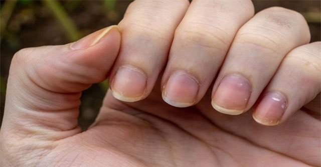 Little-noticed signs on your nails can warn you about cancer
