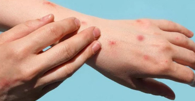 Medical waste can spread monkeypox virus