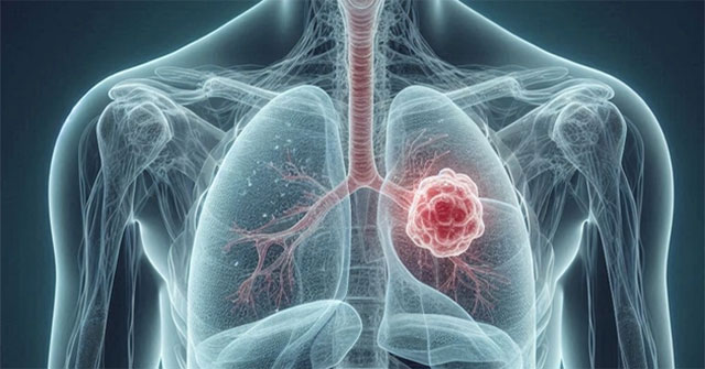 New Breakthrough: 'Hack' Tumors, Turn Cancer Cells Into Pills