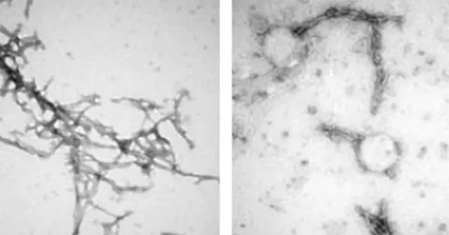 New method 'prevents' Parkinson's with nanotechnology