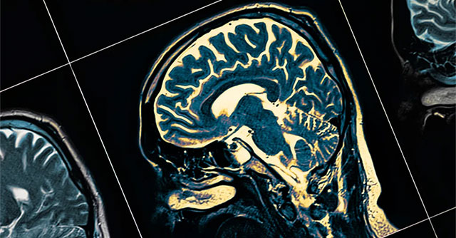 New research shows: Having mild Covid-19 can also cause changes in brain structure