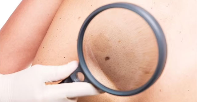 New technology on 6G phones can help detect skin cancer early