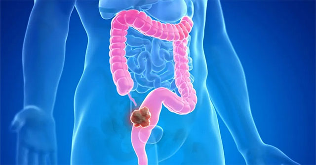 Positive trial results of drug that 'melts' cancer tumors