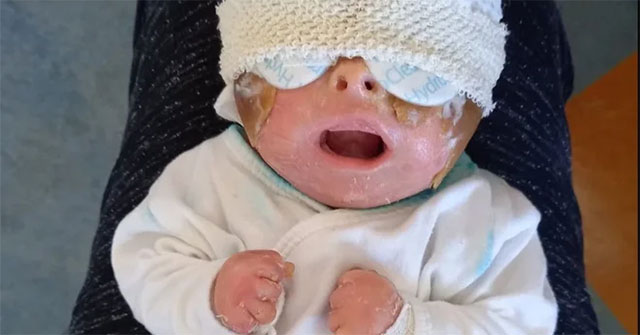Rare disease causes a girl in Slovakia to have skin as thick as a turtle's shell