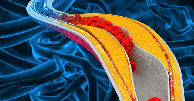 Research shows heavy metal poisoning increases the risk of cardiovascular disease