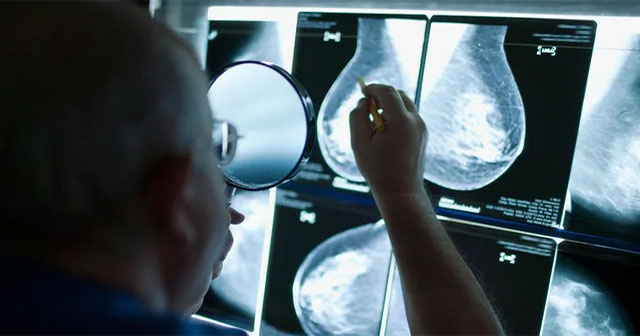 Researchers have found a chance to block breast cancer