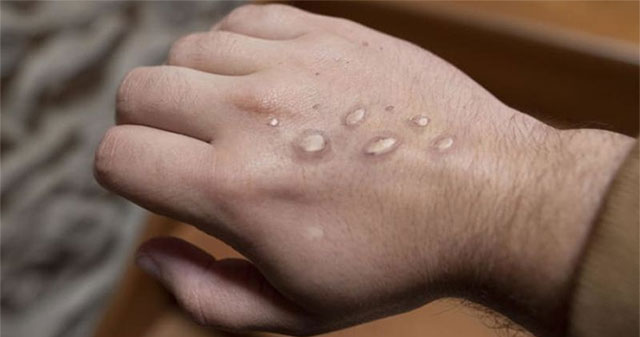 Singapore confirms first case of monkeypox