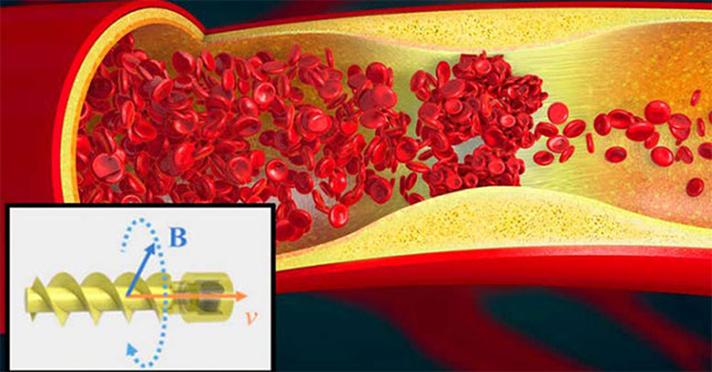 Spiral robot swims in blood vessels to break blood clots