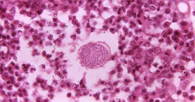 Strange disease broke out in the western United States when the weather was hot and dry