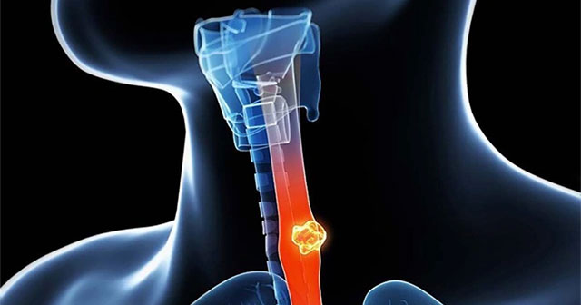 The culprits that cause esophageal cancer you didn't expect