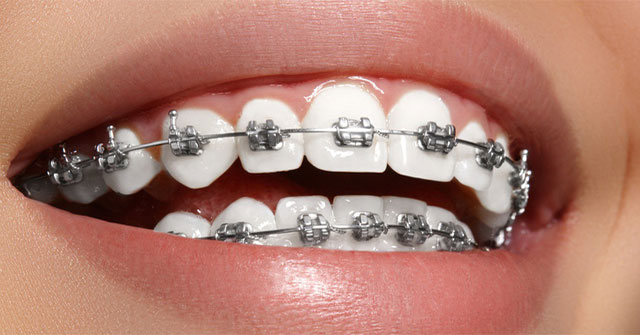 The history of orthodontics, braces and interesting secrets that few people know