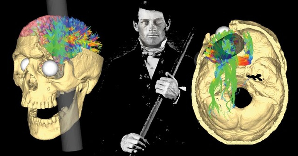 The horror of the iron bar that pierced the skull gave birth to modern neuroscience