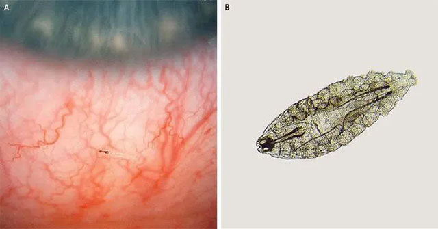 The itch doesn't go away because of the herd of 'strange creatures'... swimming in the eyes