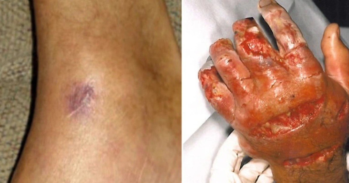 The man had to have his arm amputated by a shrimp to save his life