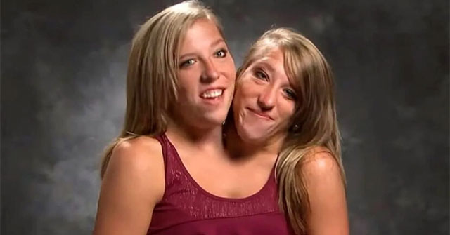 The most famous conjoined twins: Sharing the same body for 34 years, their current life is surprising