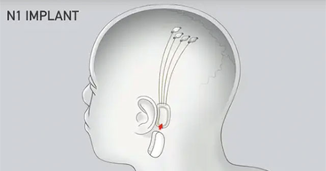 Thousands of people line up to have brain chips implanted