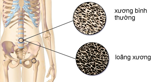 Top 4 foods are 'Kings of calcium theft', causing many people to break bones from minor falls