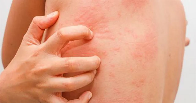 Urticaria after Covid-19, how to treat?