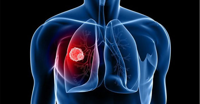US approves lung cancer drug costing 780,000 USD