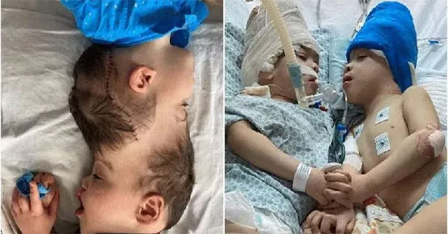 Using virtual reality technology, surgeons in the UK and Brazil successfully separated the heads of conjoined twins