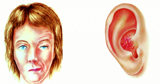 What is Ramsay Hunt Syndrome?