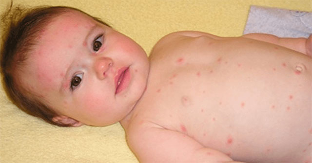 What should I do when my child has a red rash like a mosquito bite?