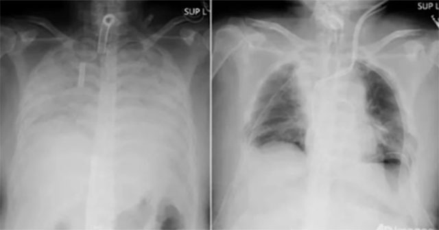 White lung disease: Causes, symptoms and treatments