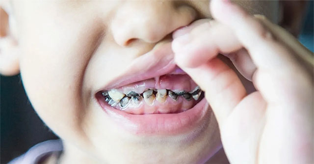 Why do children always have tooth decay?