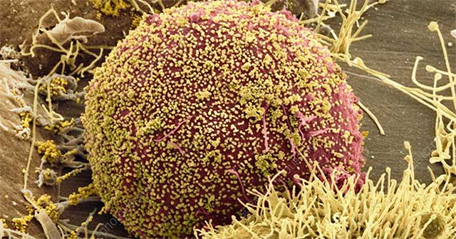 World's first woman cured of HIV thanks to stem cell transplant