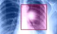 10 most dangerous cancers of all time