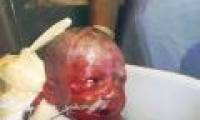 3-year-old baby has red skin