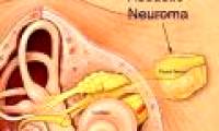 4 perpetrators suddenly caused hearing loss