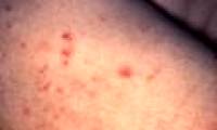 83 people died in the US syphilis experiment