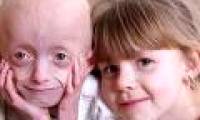 8-year-old baby got strange disease, his face was like an 80-year-old woman