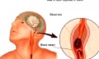 A new way of looking at stroke