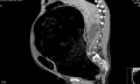 Abdominal pain, diarrhea for 1 week, the man almost lost his life due to colon