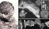 Accidentally taking a CT scan, an expert discovered the secret of 3 mummies lying inside each other, causing curiosity from 115 years ago