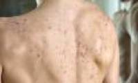 Acne on the back is a sign that the body is being made?
