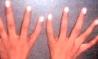 'Alien hand' syndrome makes the thumb ... turn into an index finger