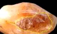 Ancient people cure toothache with beeswax