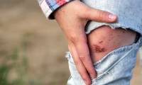 Animals that cause many cases of rabies in humans you should know