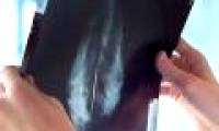 Anti-osteoporosis drugs can inhibit breast cancer