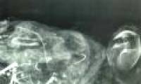Archeology of fetal remains reveals medieval abortion methods