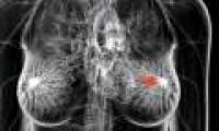 ATM genetic testing helps predict breast cancer