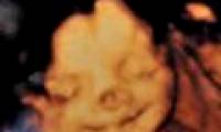 Baby girl born with circus clown nose