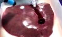 'Bio-glue' helps visceral injuries stop bleeding