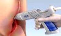 Biological glue gun for wound healing