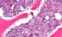 Bone marrow transplant to treat AIDS